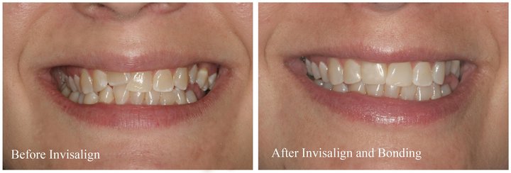 Before and After Invisalign and some cosmetic bonding